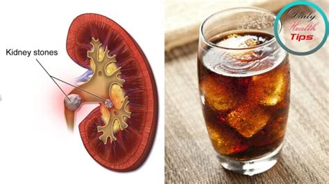 drinking soda for kidney stones.